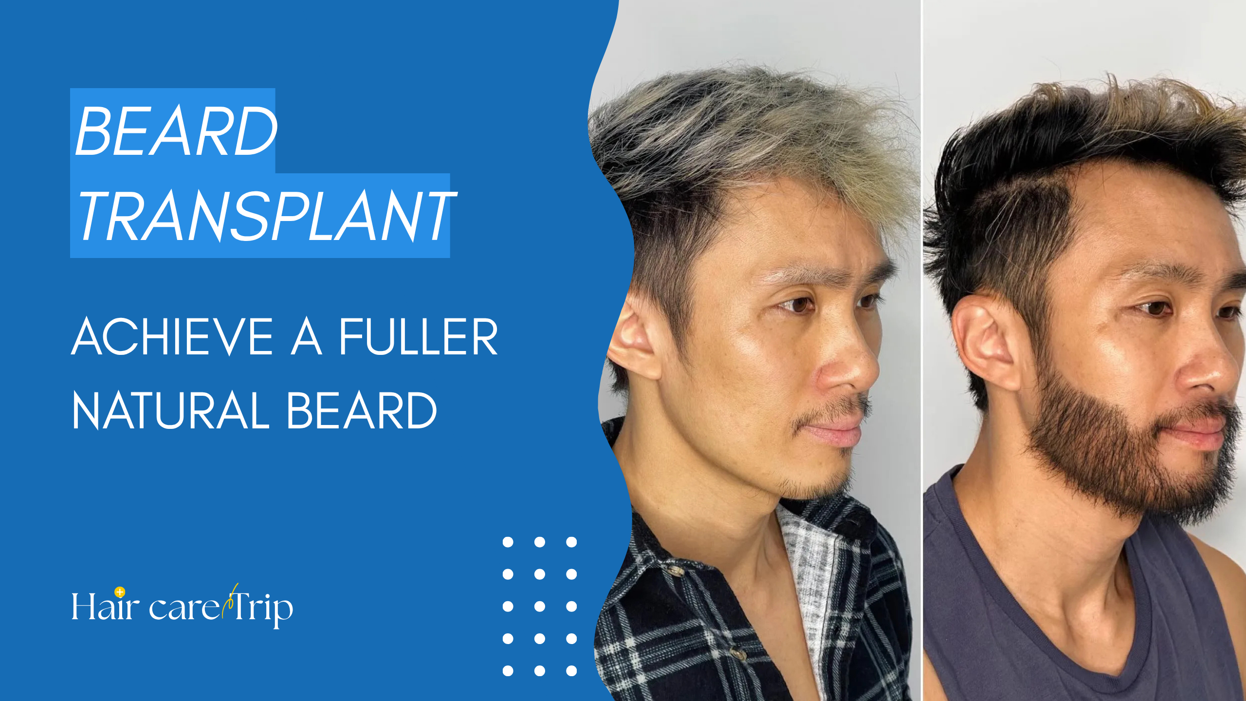 hair-care-trip-beard-transplant-1