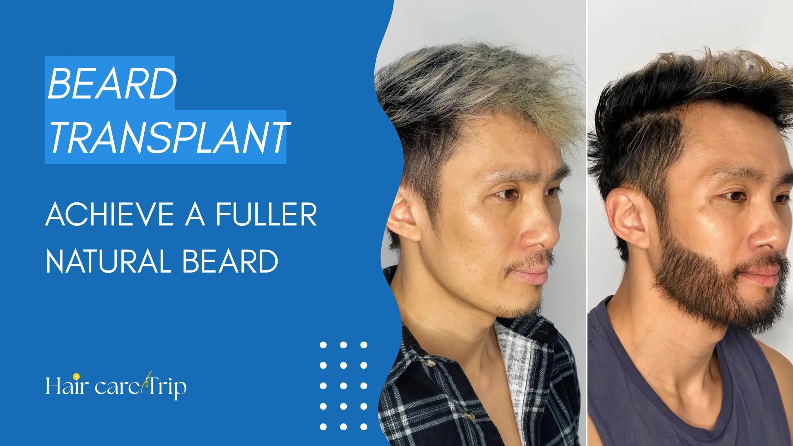 Beard Transplant: Achieve a Fuller Natural Beard