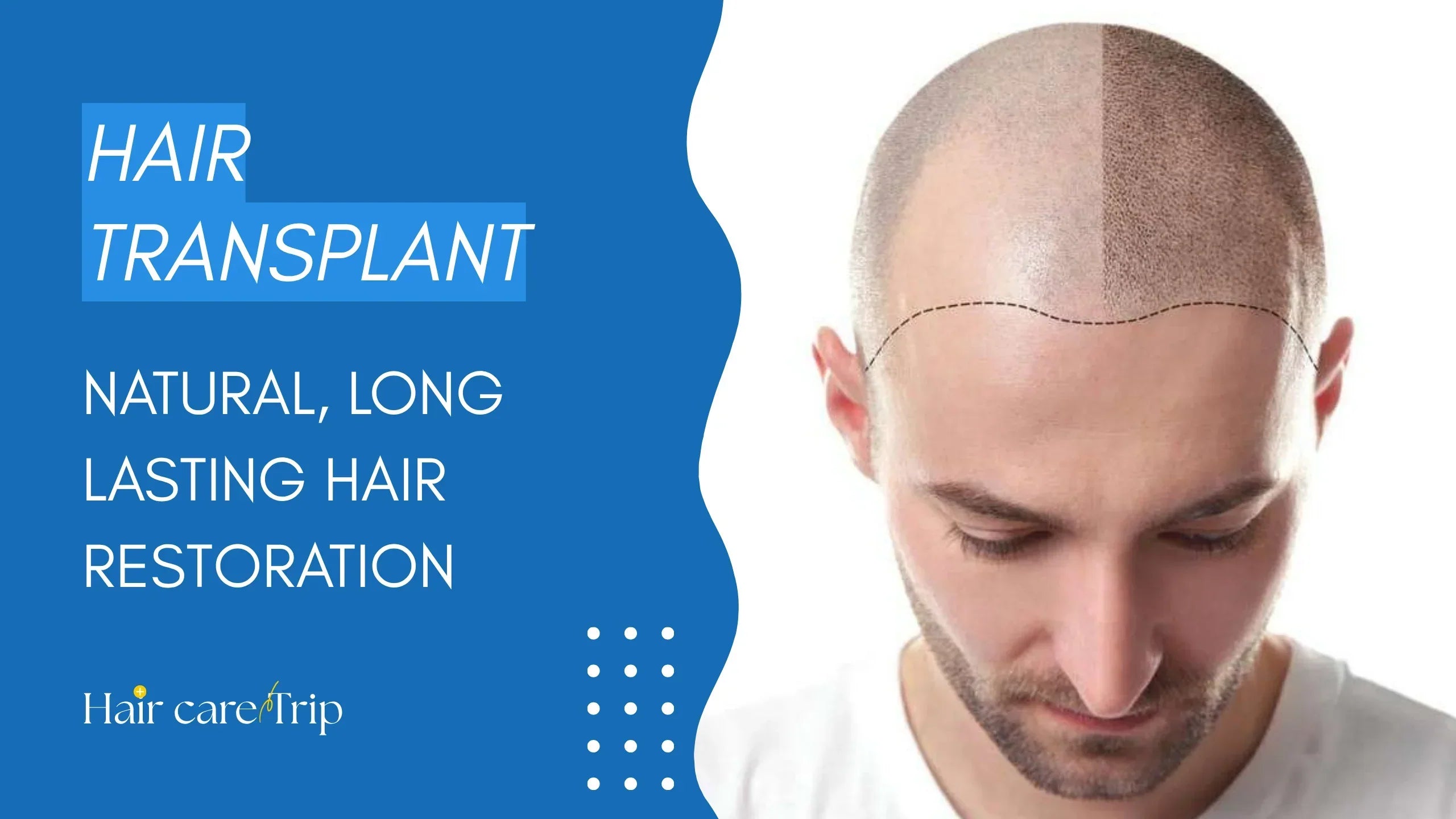 Hair Transplant: Natural, Long-Lasting Hair Restoration