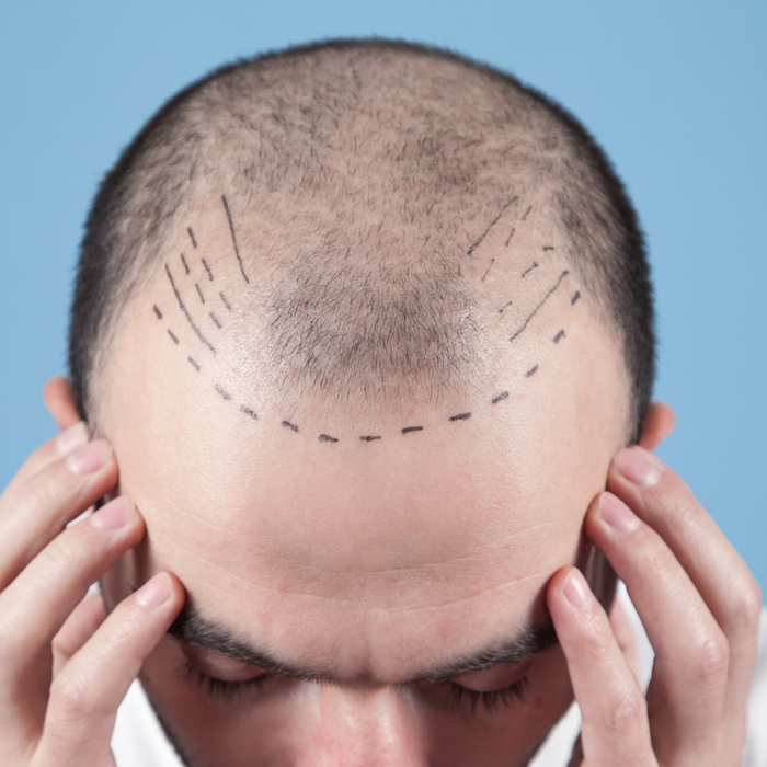 Hair Transplant Deposit