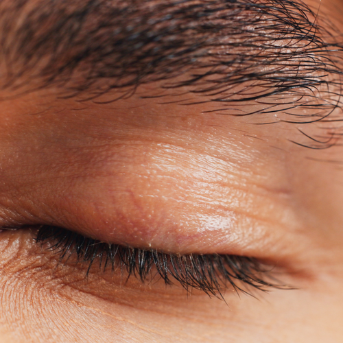 Eyebrow Transplant (Grafts)